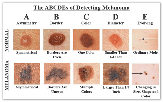 The ABCDEs of Detecting Melanoma