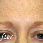 Botox® Treatments Patient 5 After
