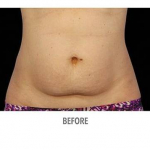 CoolSculpting Patient 2 Before