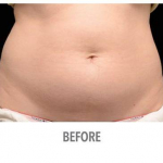 CoolSculpting Patient 5 Before