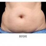 CoolSculpting Patient 6 Before