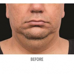 CoolSculpting Patient 9 Before