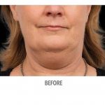 CoolSculpting Patient 10 Before