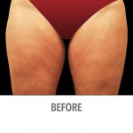 CoolSculpting Patient 11 Before