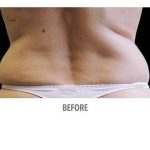 CoolSculpting Patient 13 Before