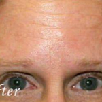 Botox® Treatments Patient 2 After