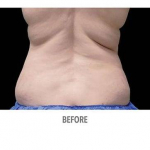 CoolSculpting Patient 14 Before
