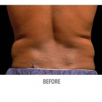 CoolSculpting Patient 15 Before