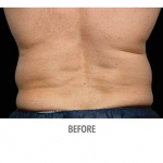 CoolSculpting Patient 16 Before