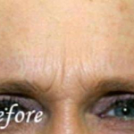 Botox® Treatments Patient 4 Before