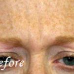 Botox® Treatments Patient 5 Before
