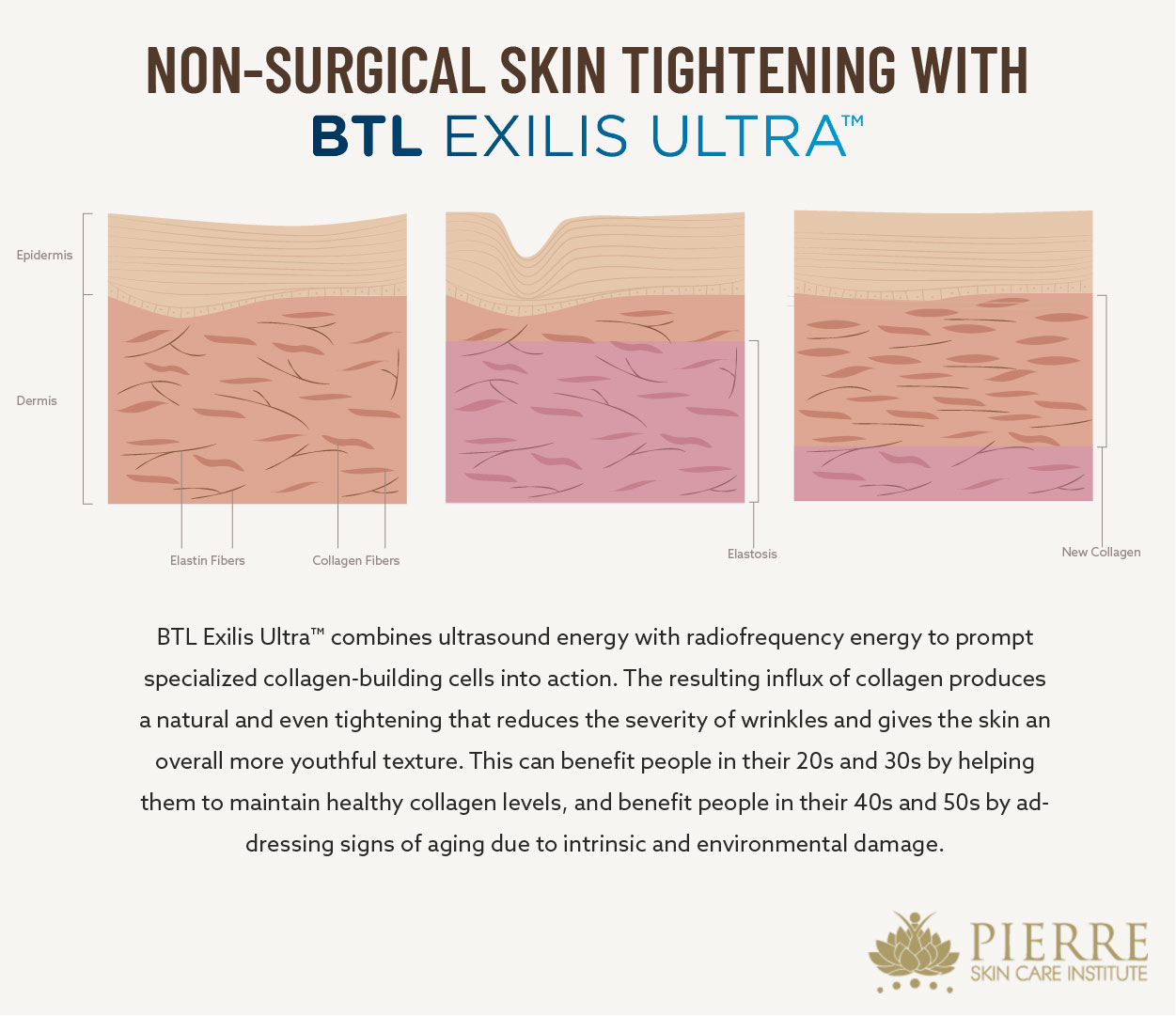 Discover the dual-energy-powered benefits of BTL Exilis Ultra™ for noninvasive skin tightening at Thousand Oaks' Pierre Skin Care Institute.
