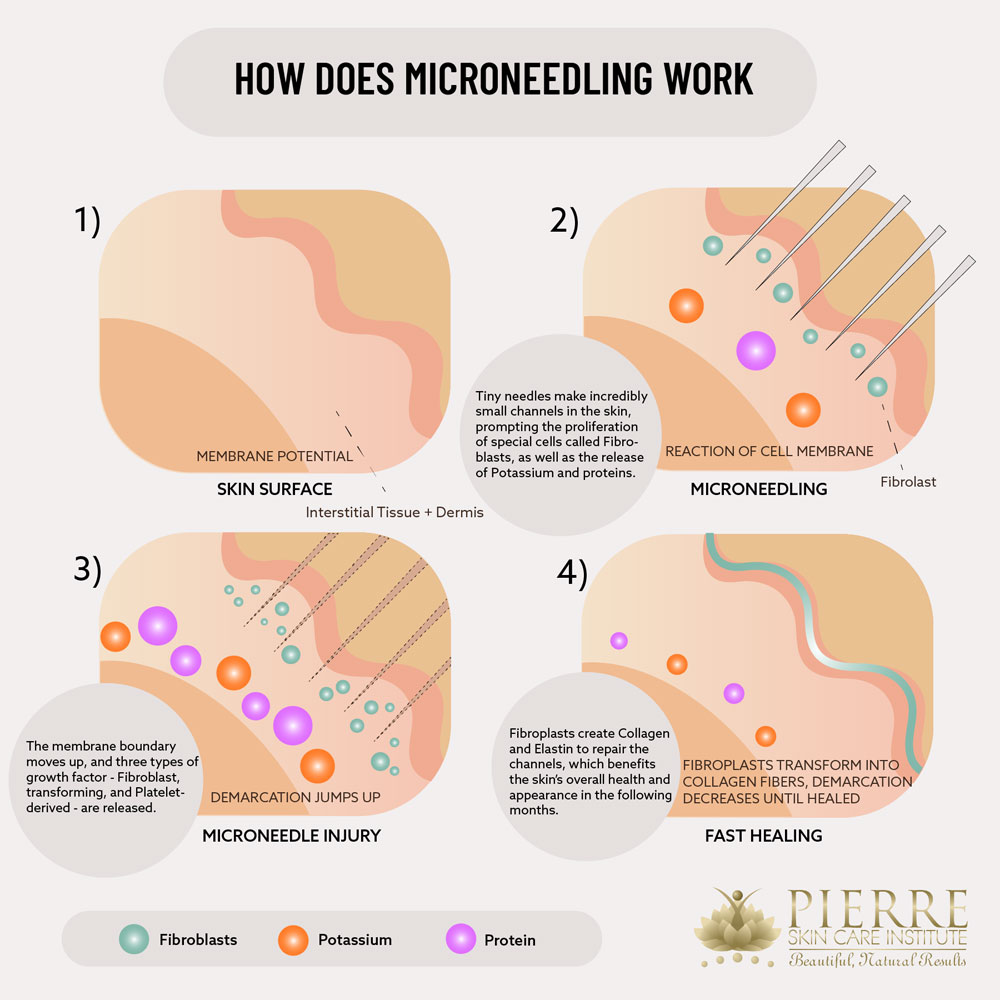 Learn the steps involved in microneedling at Thousand Oaks' Pierre Skin Care Institute.