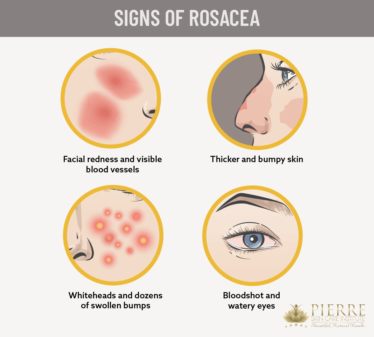 Watch for signs of rosacea at Westlake Village's Pierre Skin Care Institute.