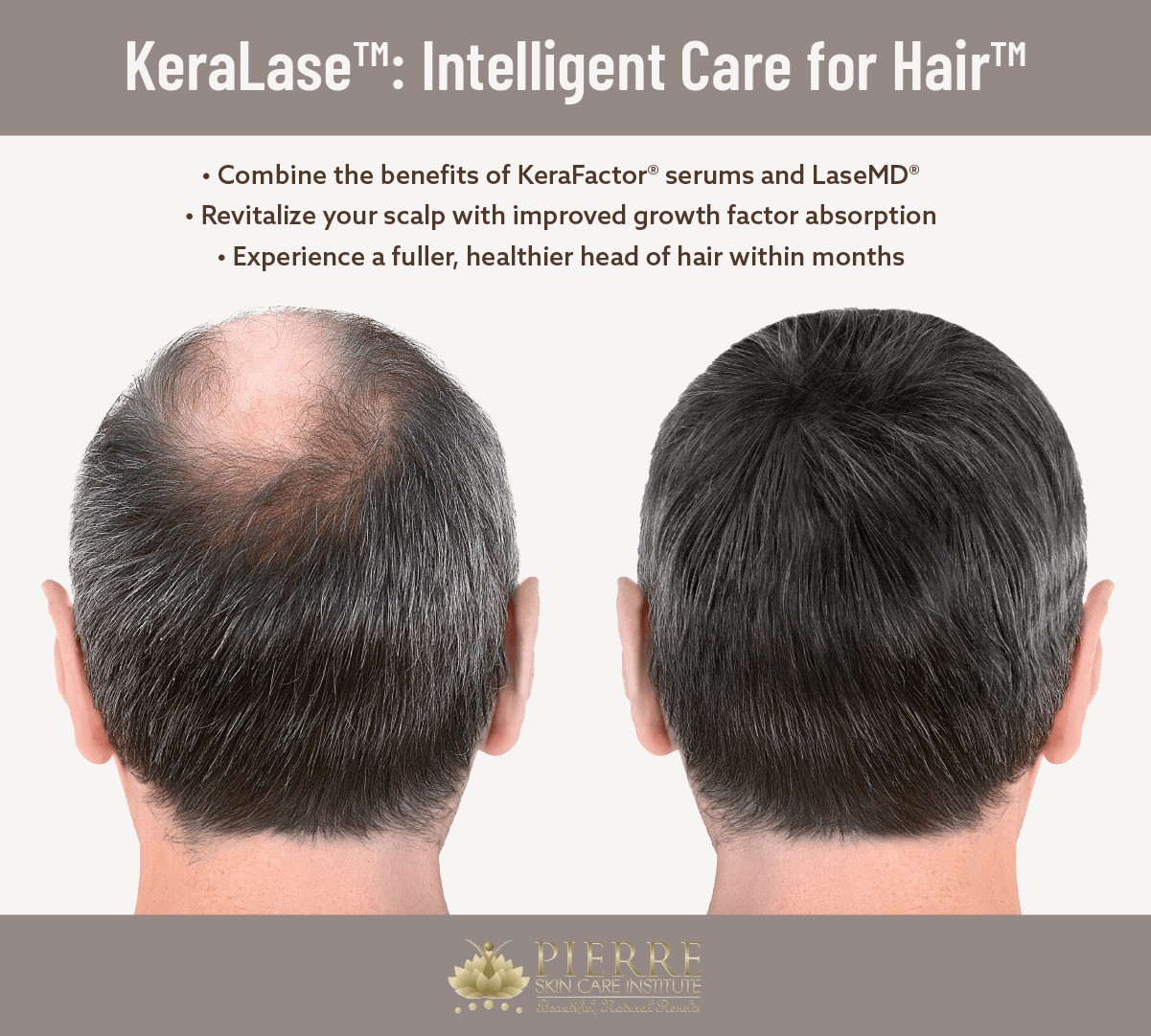See what makes KeraLase™ at Thousand Oaks’ Pierre Skin Care Institute “intelligent care.”