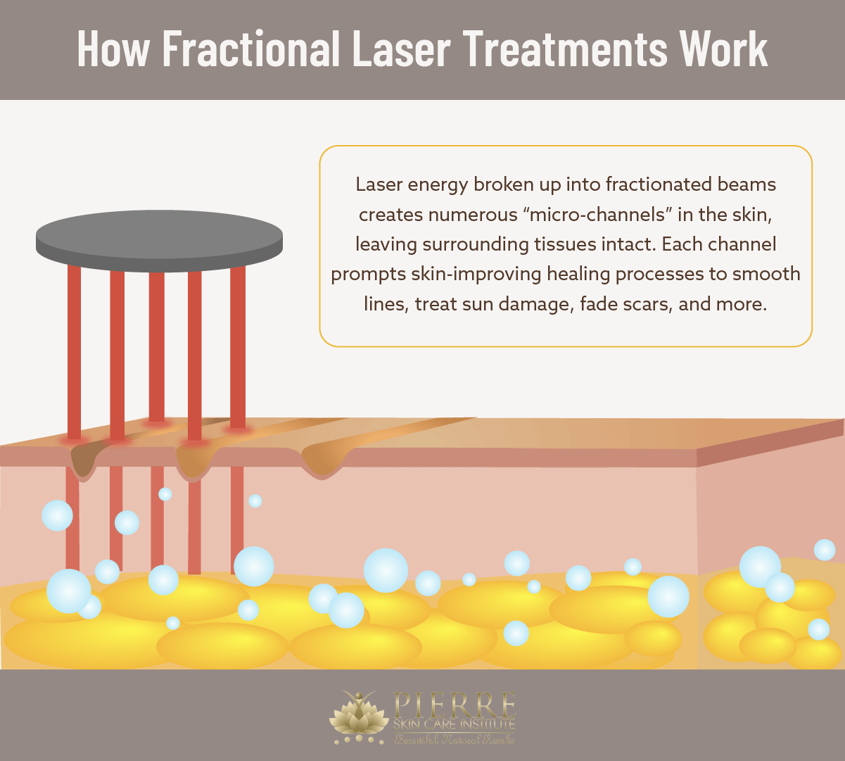 Learn more about laser skin resurfacing at Thousand Oaks’ Pierre Skin Care Institute.